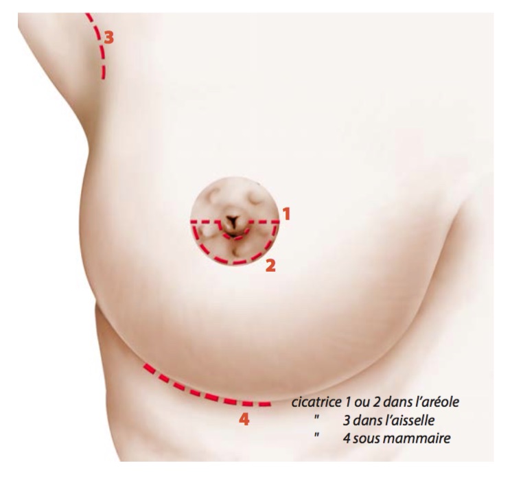 Localisation de la cicatrice pour une augmentation mammaire par implants
