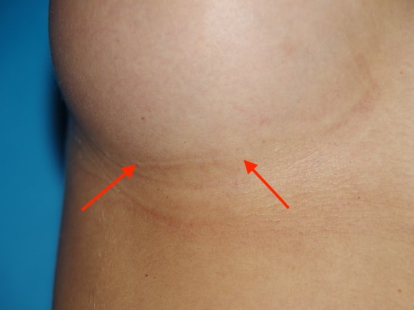 Cicatrice sous-mammaire