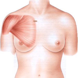 muscle grand pectoral couverture prothèse implant augmentation mammaire seins poitrine