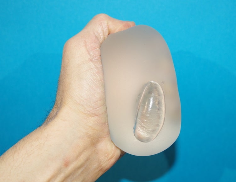 Implant mammaire dont l'enveloppe a été perforée