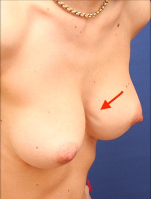 pli visible implant mammaire vague