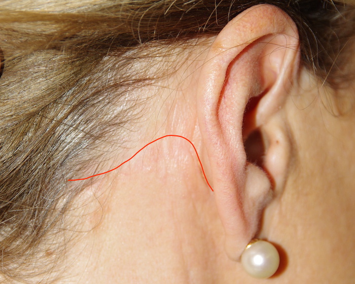 Trajet de la cicatrice derrière l'oreille