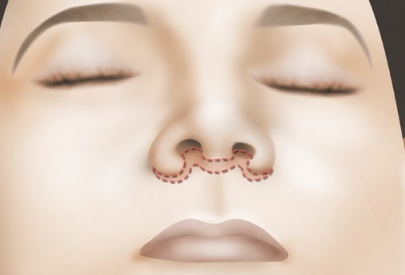 Lip lift - Bull horn technique