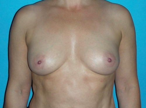 6 mois après lipomodelage des seins