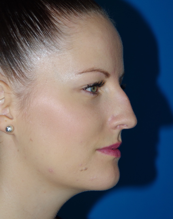 Rhinoplastie Annecy Bottero Retirer une bosse sur le nez