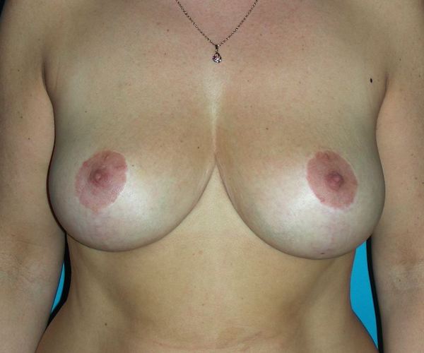 Cicatrices en ancres 2 ans après la réduction mammaire, chez la même patiente