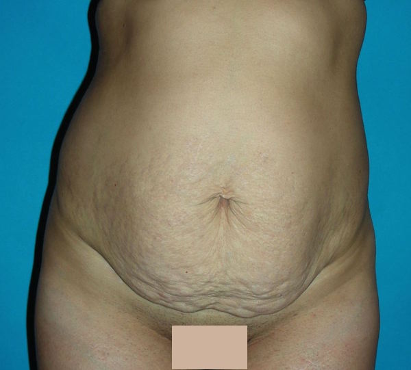 L'abdominoplastie (plastie abdominale), chirurgie esthétique du ventre