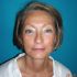 4 mois après lifting cervico-facial et blépharoplastie