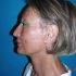 4 mois après lifting cervico-facial et blépharoplastie