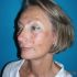 4 mois après lifting cervico-facial et blépharoplastie