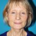4 mois après lifting cervico-facial et lipostructure (transfert de graisse)