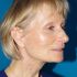 4 mois après lifting cervico-facial et lipostructure (transfert de graisse)