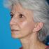6 mois après lifting cervico-facial