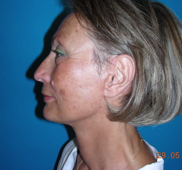 4 mois après lifting cervico-facial et blépharoplastie