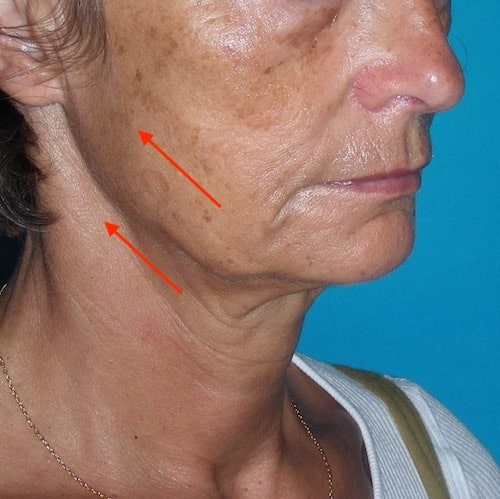Objectif du lifting cervico-facial : repositionner les tissus du bas du visage et du cou