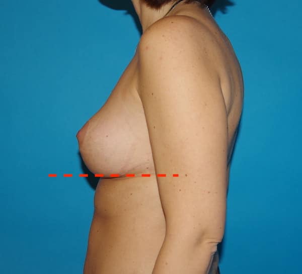Après cure de ptose, lifting des seins