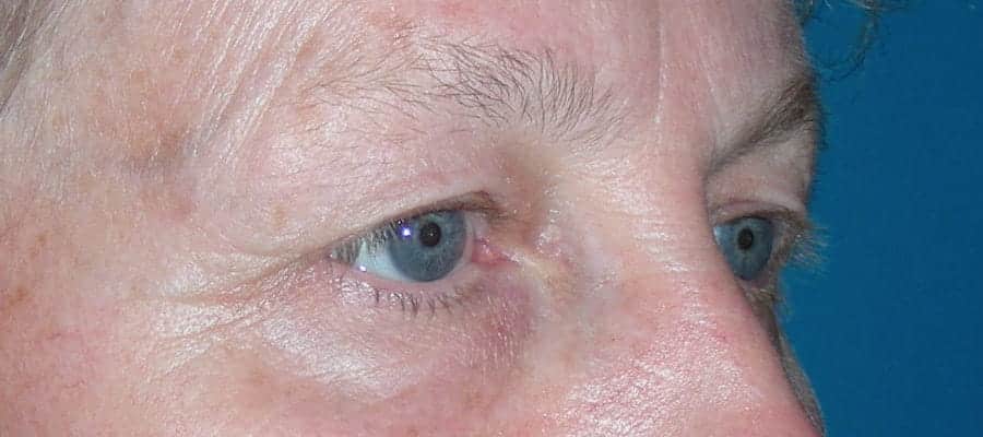 Paupières supérieures tombantes avant blépharoplastie