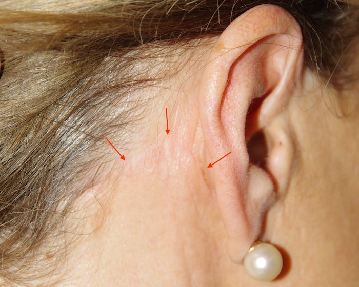 Cicatrice derrière l’oreille, dissimulée dans les cheveux