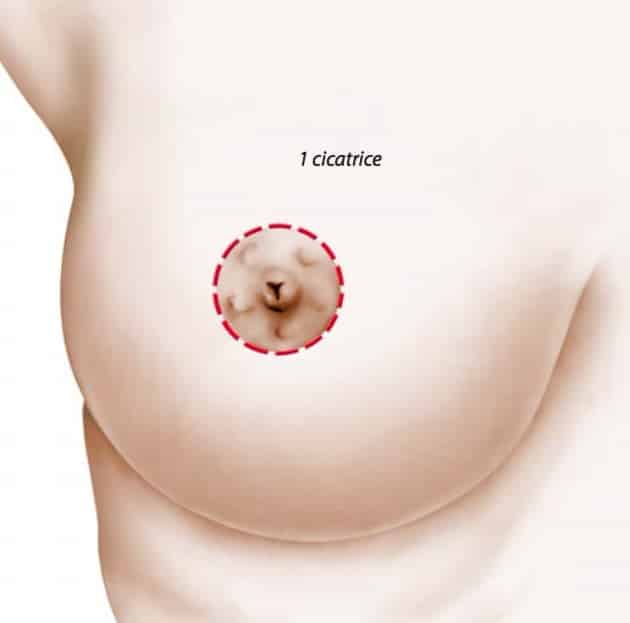Lifting des seins par round block, cicatrice autour de l’aréole