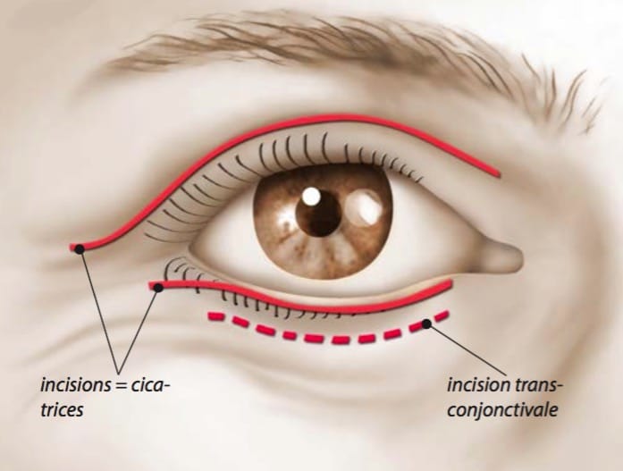 Trajet des cicatrices après blépharoplastie supérieure et inférieure