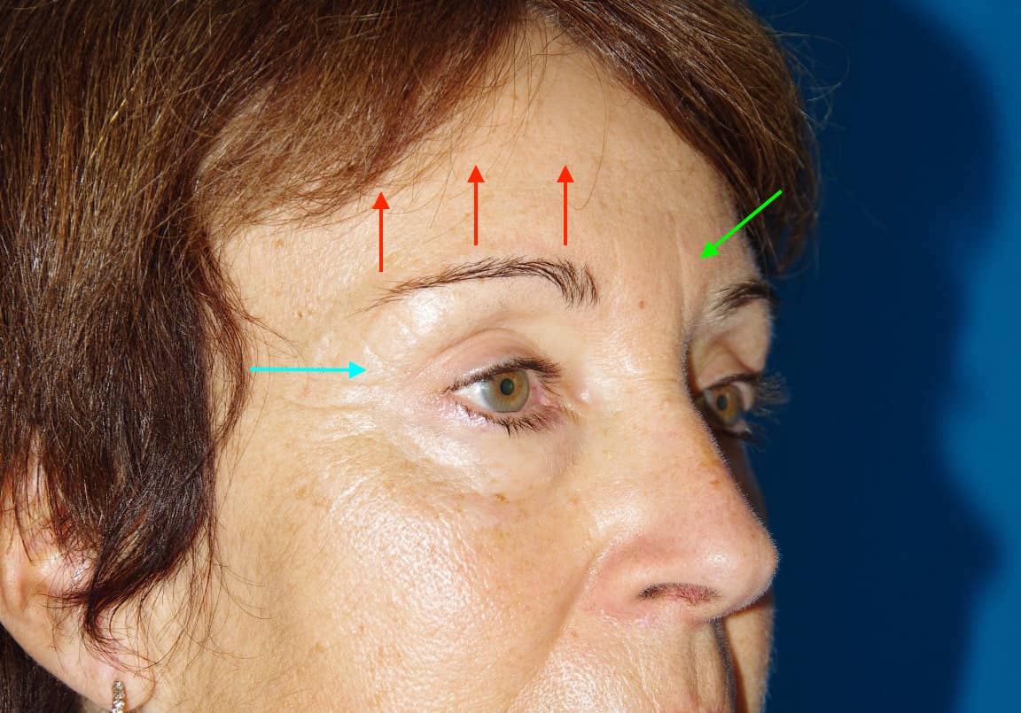 Après lifting fronto-temporal et blépharoplastie supérieure