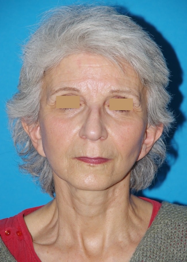 6 mois après lifting cervico-facial