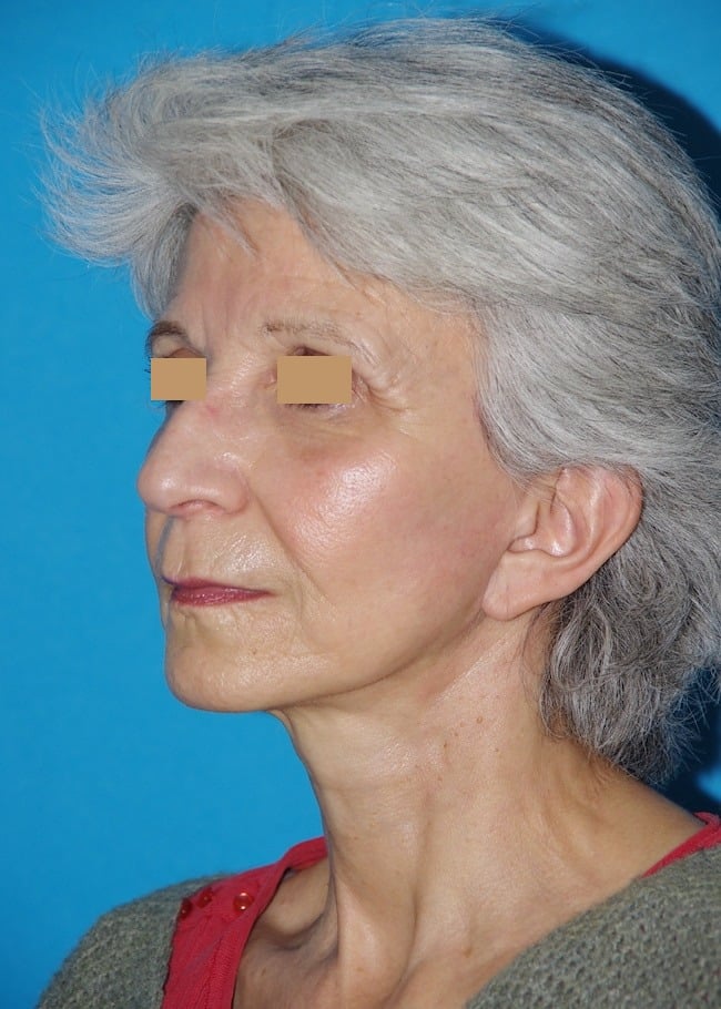 6 mois après lifting cervico-facial
