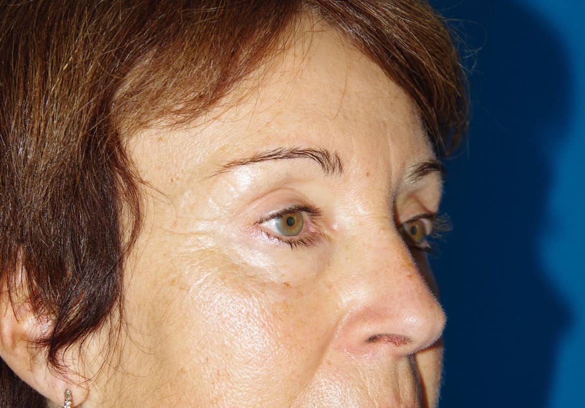6 mois après lifting fronto-temporal et blépharoplastie supérieure, de face