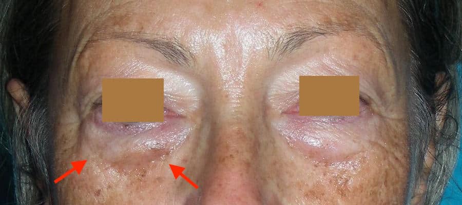 Poches sous les yeux sur les paupières inférieures