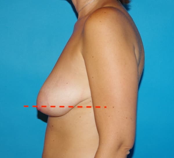 Ptose mammaire avant lifting des seins